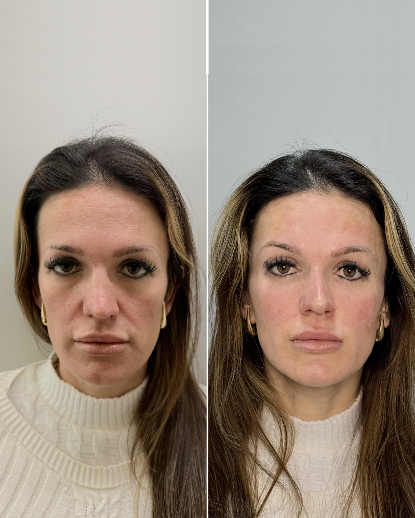 Depois: Natural Contour